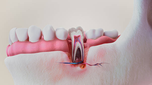 Gum Disease Treatment Stoney Creek & Hamilton | Fletcher Dental