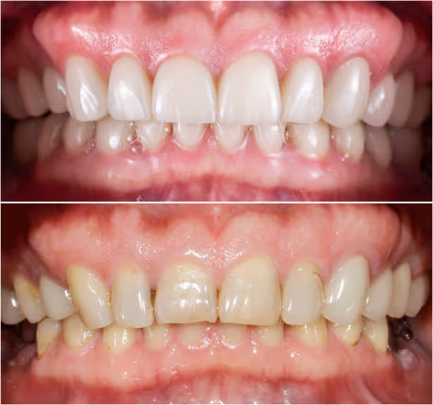 Teeth Whitening at Fletcher Dental Centre in Hamilton