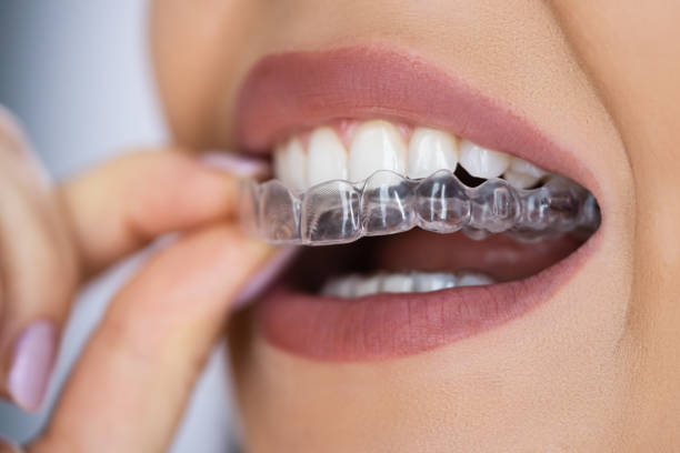 Invisalign Near Me in Stoney Creek: What You Need to Know Before Starting Treatment