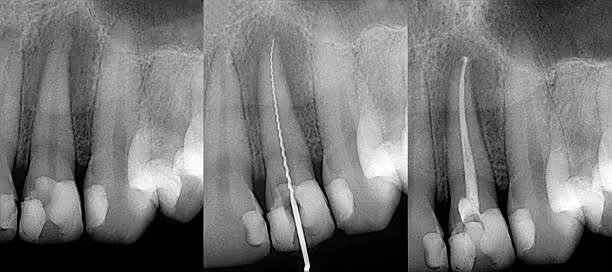 Root Canals at Fletcher Dental Centre in Hamilton