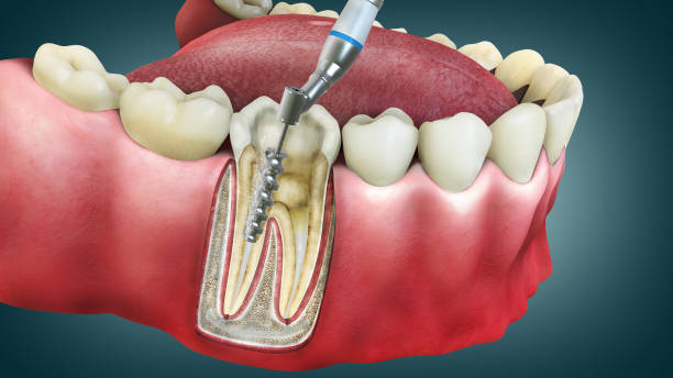Root Canal Stoney Creek & Hamilton | Fletcher Dental Centre