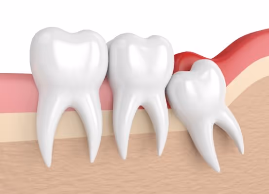 Do You Need Your Wisdom Teeth Removed?